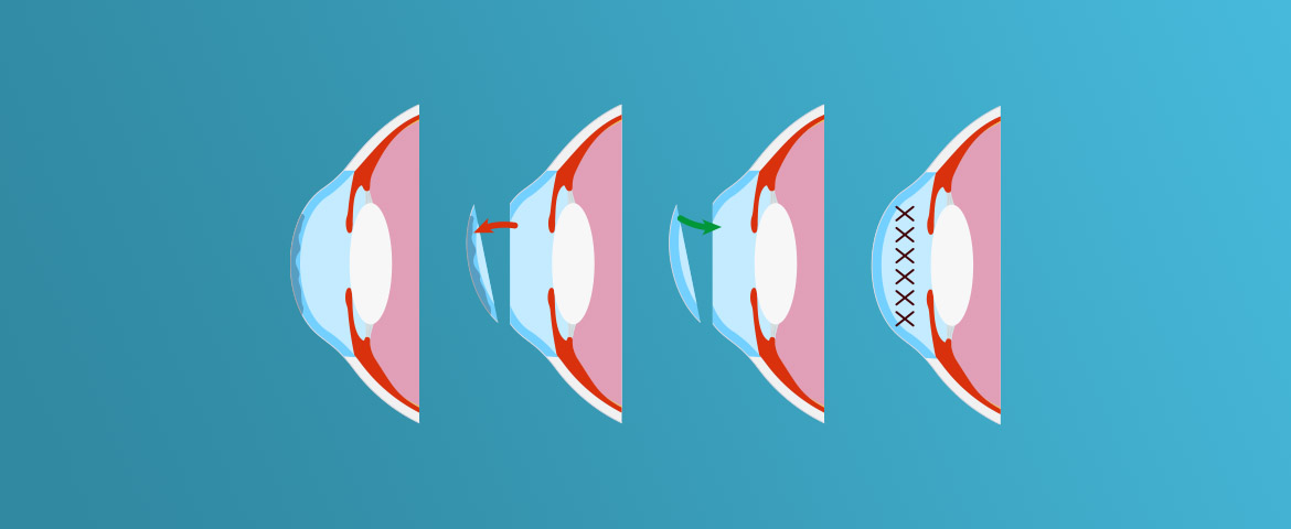 پیوند قرنیه