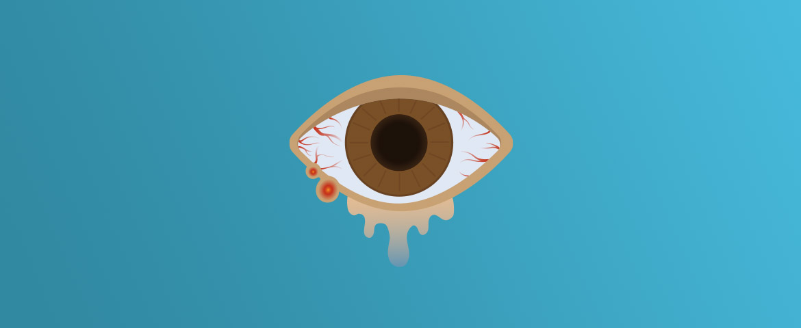 انسداد مجرای اشکی چیست؟