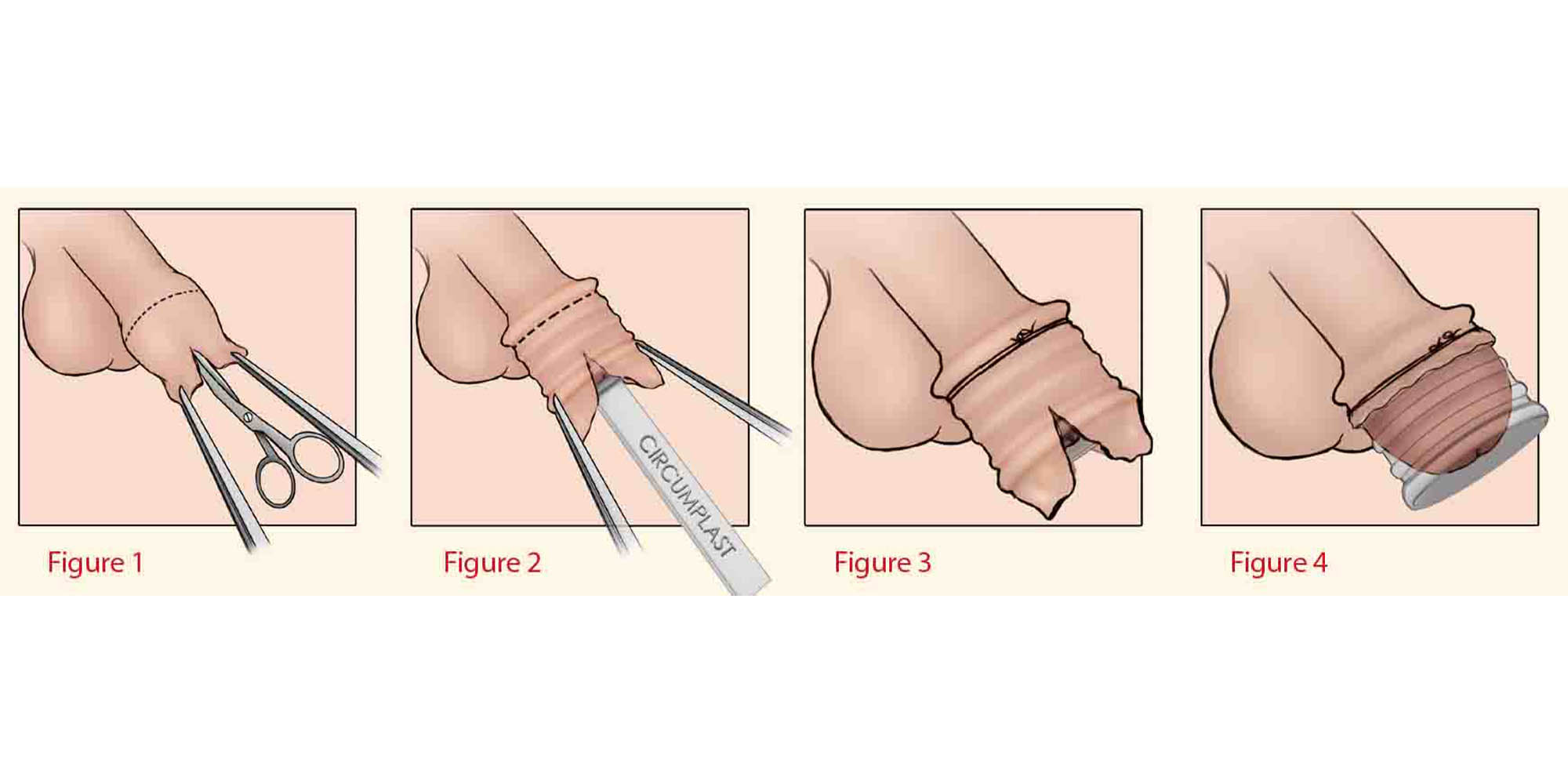 عکس ختنه نادرست نوزاد